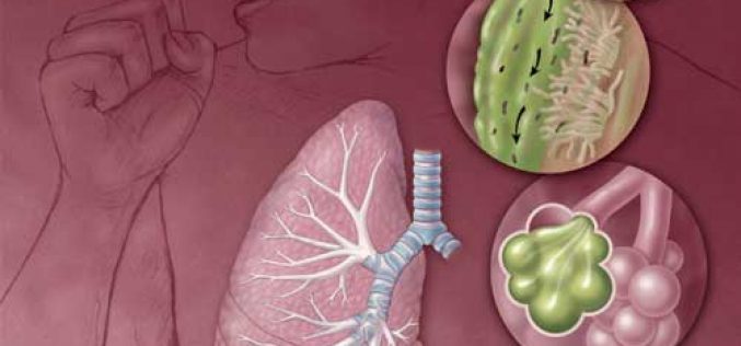 Cùng tìm hiểu bệnh viêm phổi mắc phải tại cộng đồng