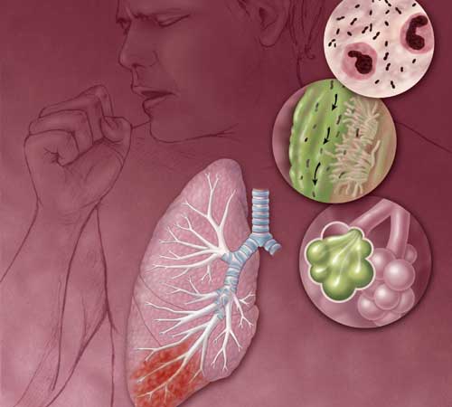 Cùng tìm hiểu bệnh viêm phổi mắc phải tại cộng đồng