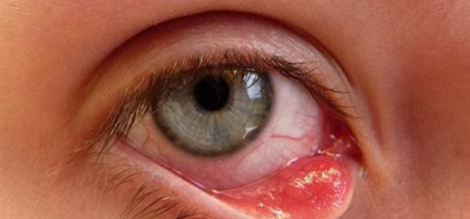 Viêm bờ mi mắt: Nguyên nhân và cách điều trị hiệu quả