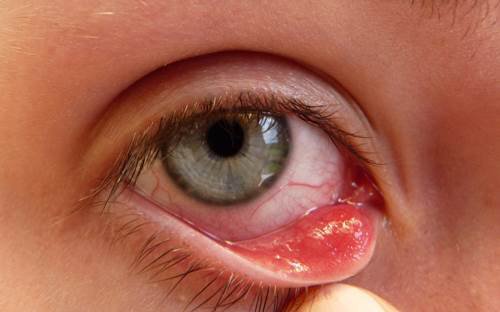 Cách điều trị viêm bờ mi mắt hiệu quả