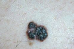 Các dấu hiệu nhận biết ung thư da phát triển từ mụn ruồi