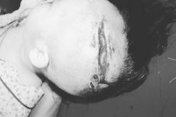 Cháu bé 2 tuổi ở Hà Nội bị chó tấn công lộ xương sọ, mất máu nhiều