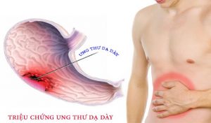 4 dấu hiệu cảnh báo bệnh ung thư dạ dày đang phát triển