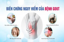 Những biến chứng nguy hiểm của bệnh Gout