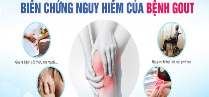 Những biến chứng nguy hiểm của bệnh Gout